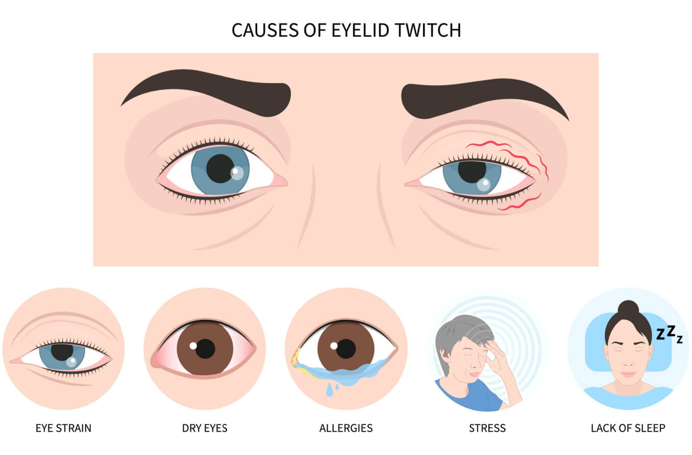 Graphic showing different causes of eyelid twitching.