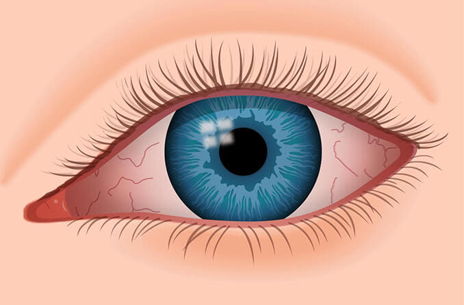 dry eye illustration