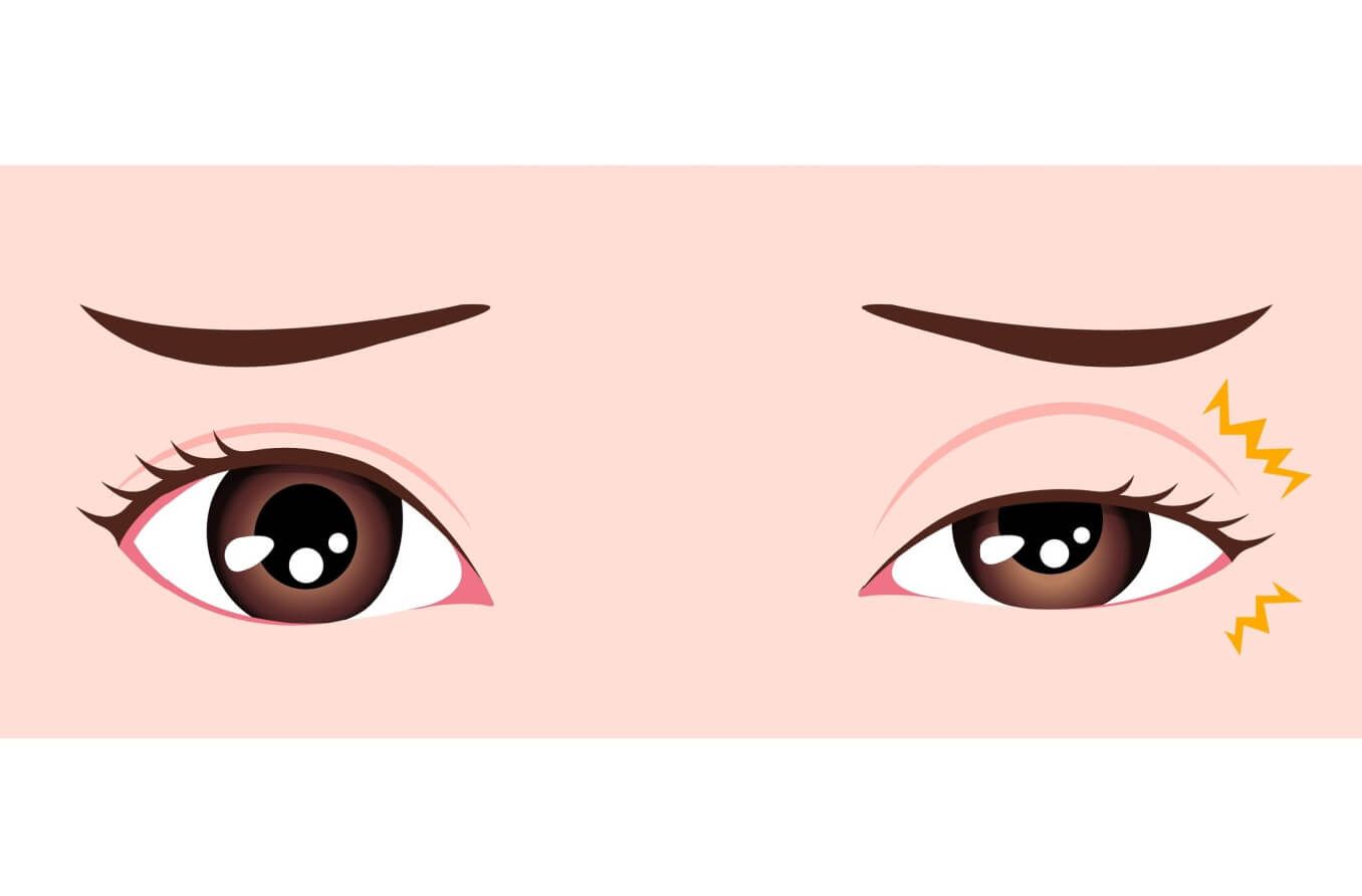 ilustración de un ojo con mioquimia y sus causas