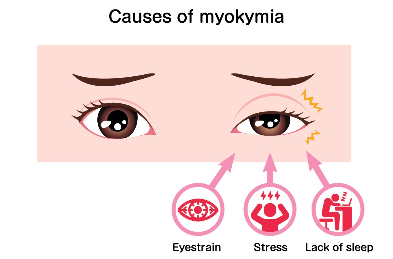 illustration of an eye with myokymia and its causes