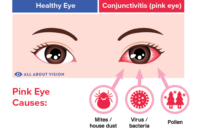 Pink Eye (Conjunctivitis) Causes - All About Vision