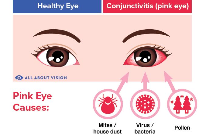 illustration of pink eye (conjunctivitis) causes