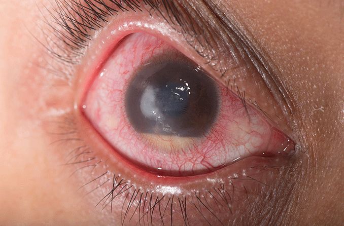closeup of an eye with buildup of intraocular fluid or endophthalmitis