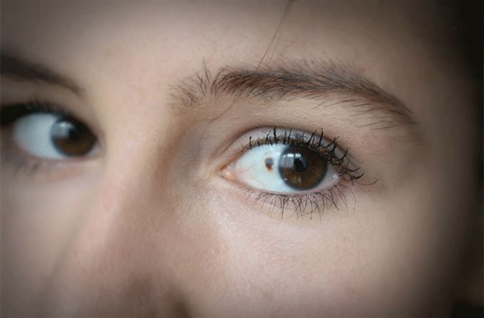 closeup of a woman's eye with ocular melanoma