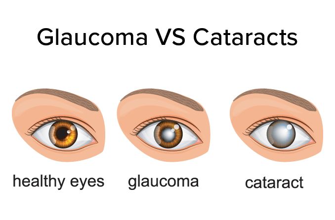illustration of eye with glaucoma vs eye with cataracts