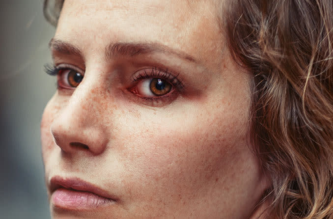 Woman with red eyelids