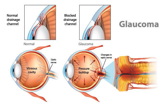 Illustration showing open-angle glaucoma. Intraocular pressure in the back of the eye.