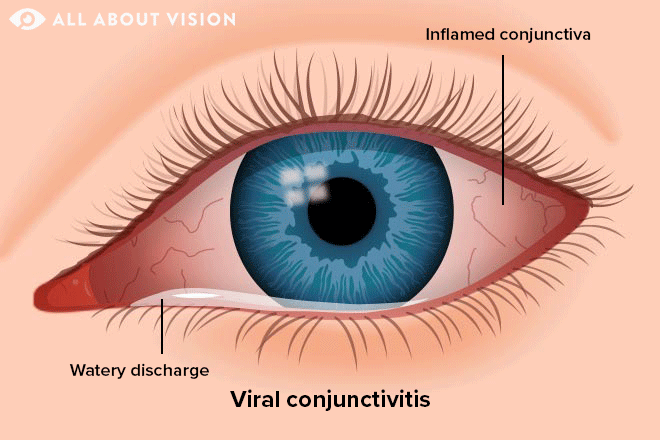 Types Of Conjunctivitis Pink Eye All About Vision