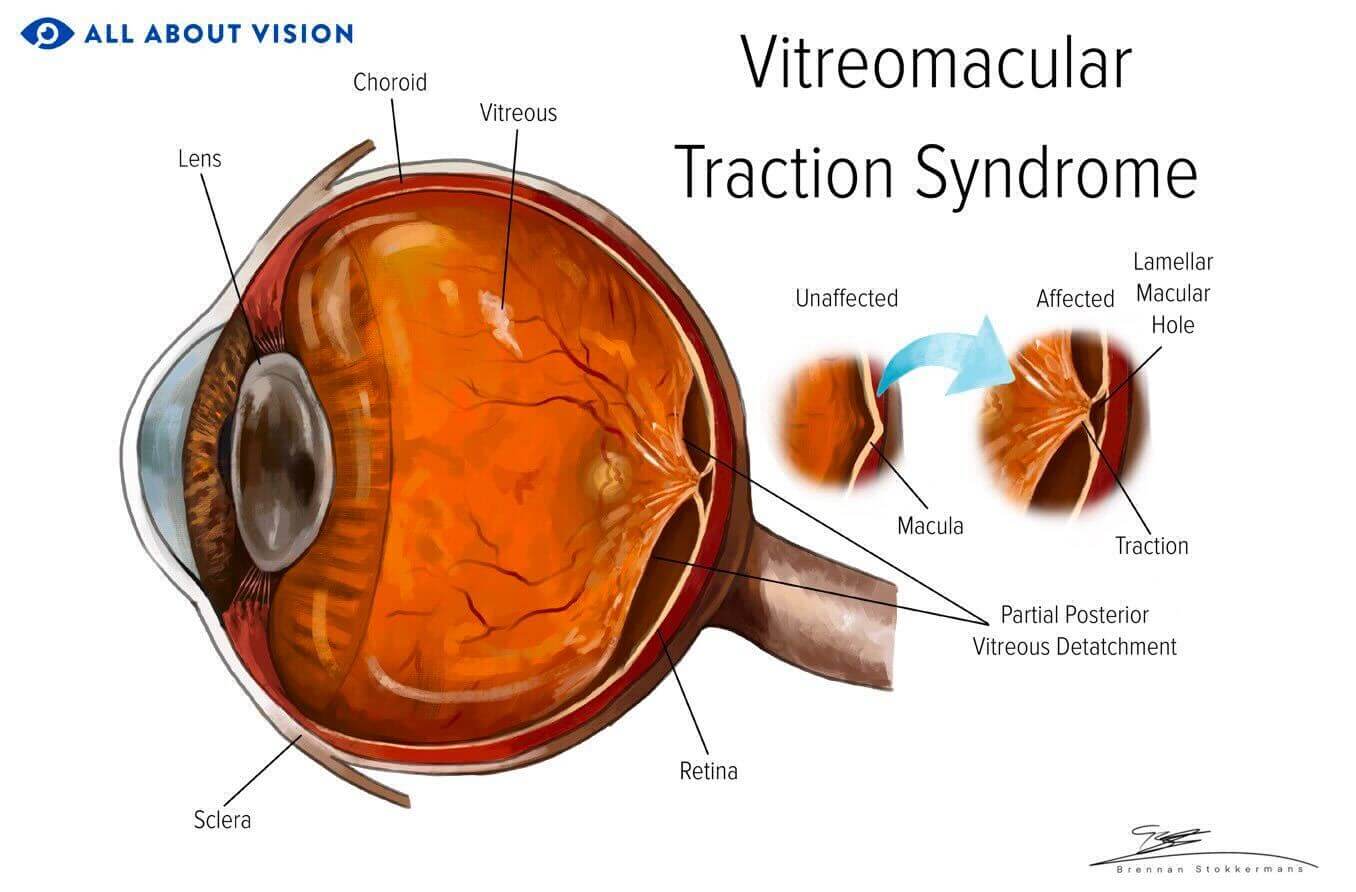 Illustration of vitreomacular traction syndrome