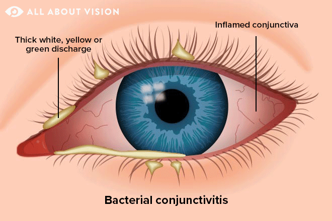 difference between viral and bacterial pink eye