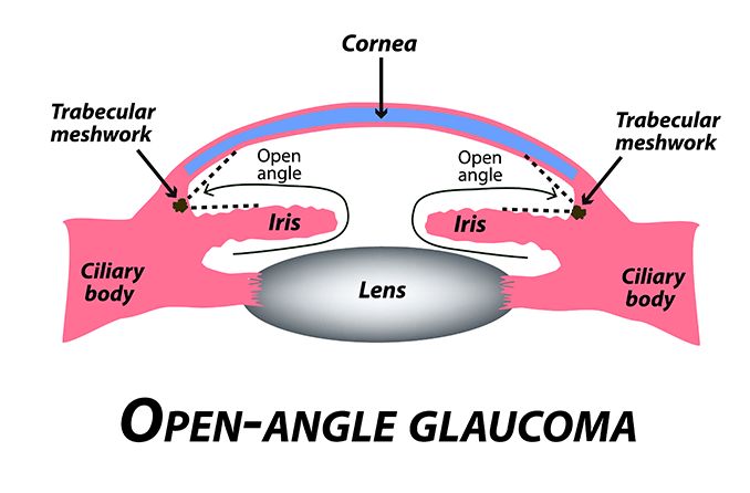 illustration of primary open-angle glaucoma