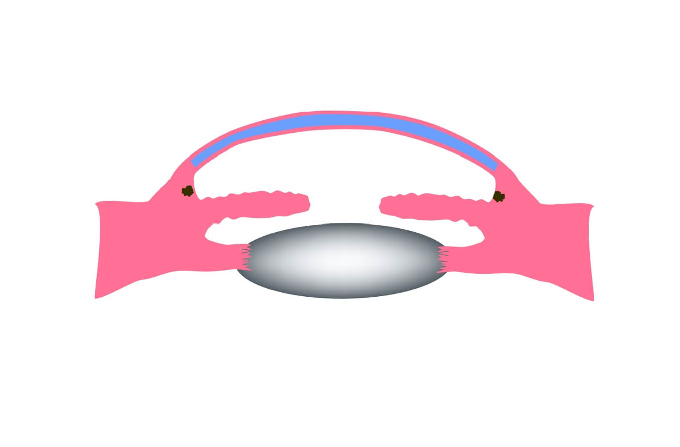 ilustración de glaucoma primario de ángulo abierto