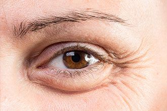 Bags Under Eyes Causes Treatments and Solutions