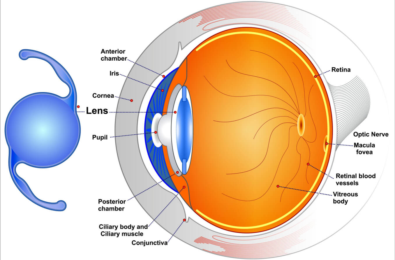 Intraocular lenses: (IOLs) are medical devices that are implanted inside the eye to replace the eye's natural lens when it is removed during cataract surgery.