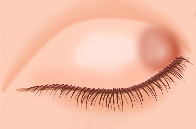Illustration of a chalazion or lump on eyelid
