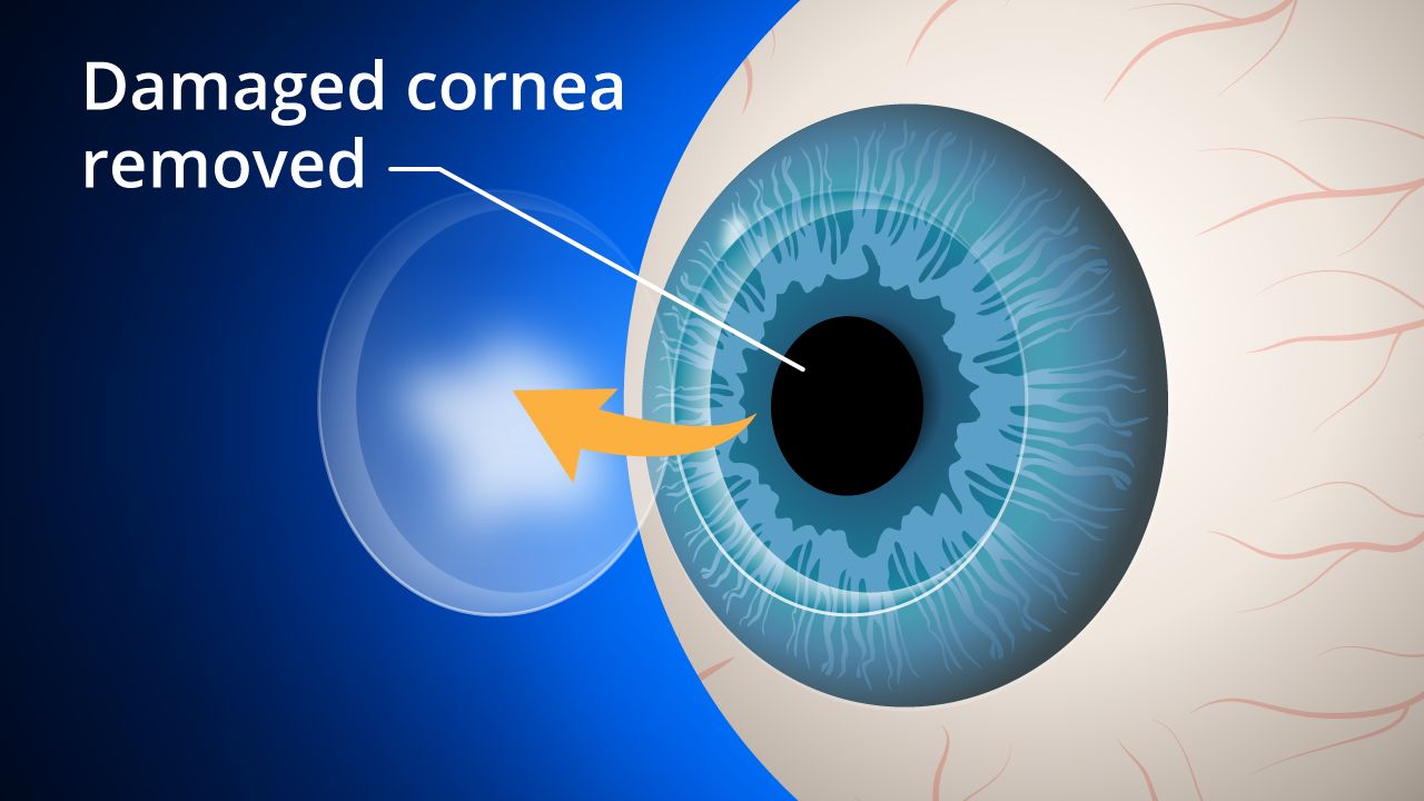 cornea transplant illustration