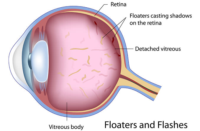 eye floaters eyeball illustration