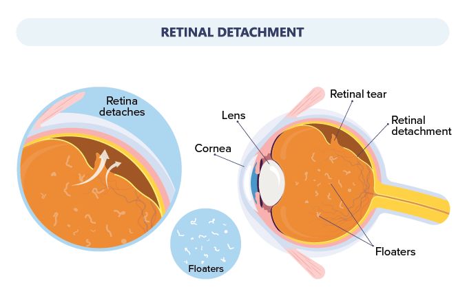 illustration of an eyeball with retinal detachment causing blindness
