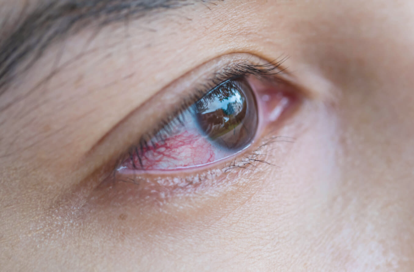 结膜炎的眼睛的特写