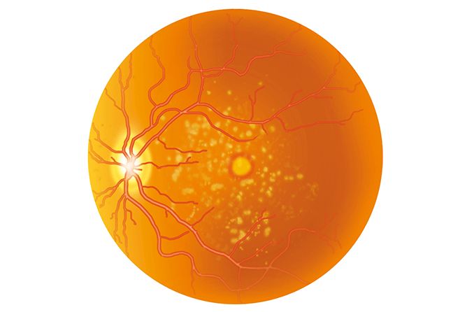 illustration of retinal drusen of the eye