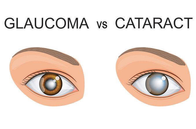 Glaucoma Vs Cataracts Understanding The Difference 