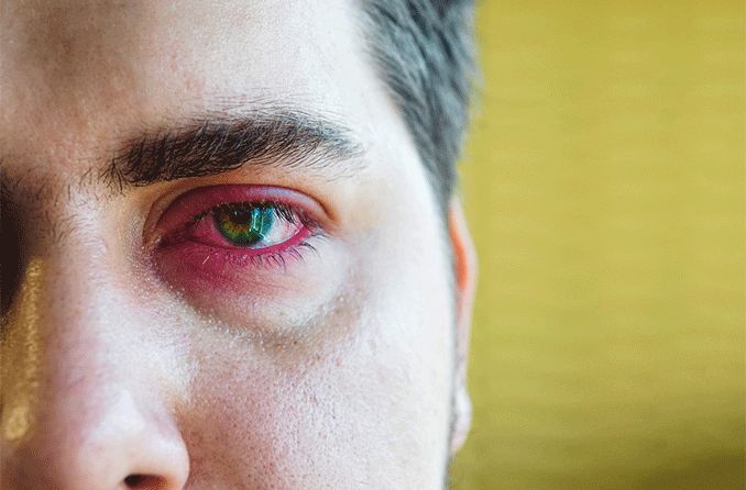 man with eye inflammation
