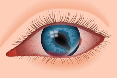 Blessures oculaires : Traitement des traumatismes oculaires | Tout ...