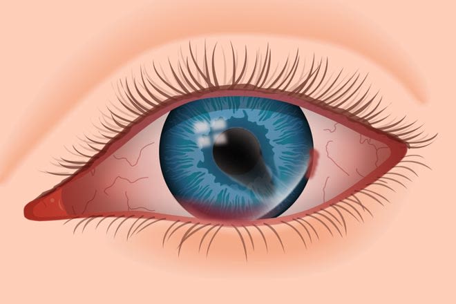 Điều trị chấn thương mắt: Mắt là bộ phận rất quan trọng của cơ thể chúng ta. Tham gia vào hình ảnh về \