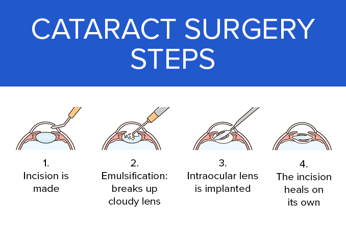 Decoding Cataract Surgery: Clear Vision Ahead