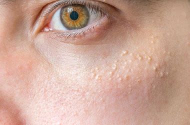 How To Get Rid Of Milia Tiny Bumps On Eyelids