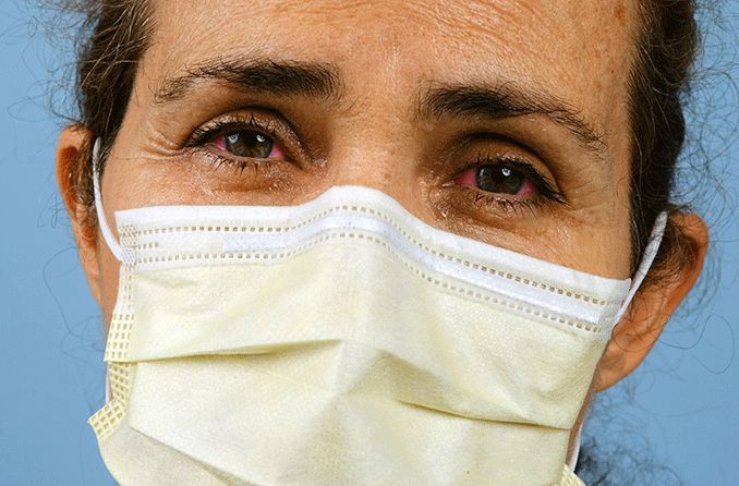 woman wearing a surgical mask who has coronavirus red eyes