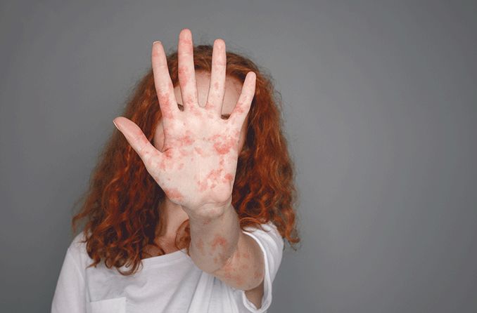 woman with measles putting her hand up to block her face and eyes