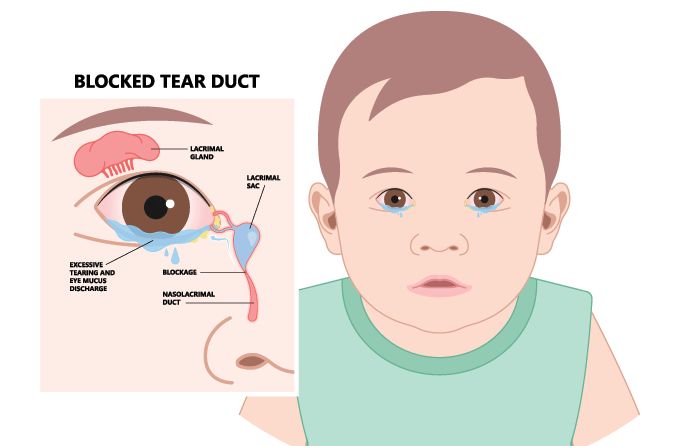 illustration of blocked tear ducts in babies