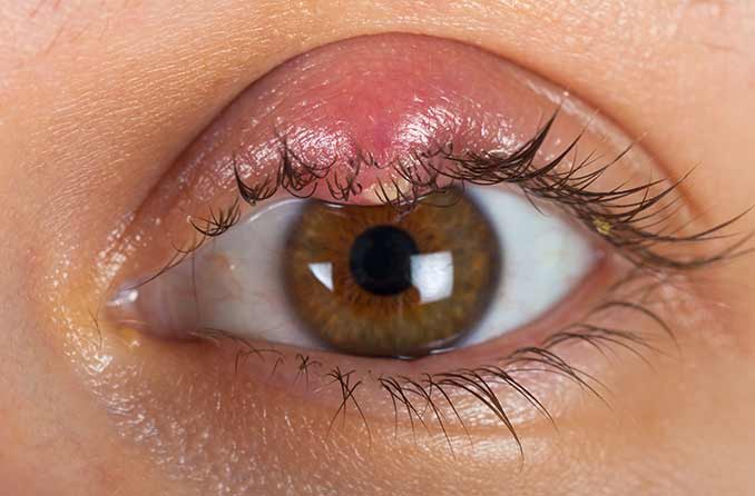 upper eyelid infection