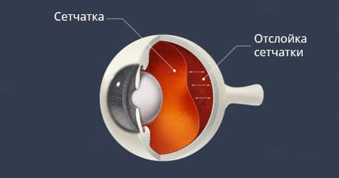 Схема отслойки сетчатки