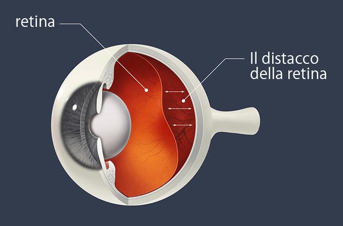 Diagramma del distacco della retina