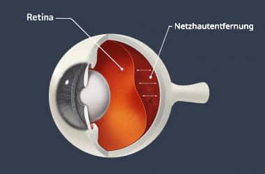 Netzhautablösungsdiagramm