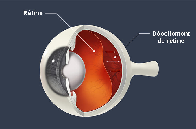diagramme de décollement de la rétine