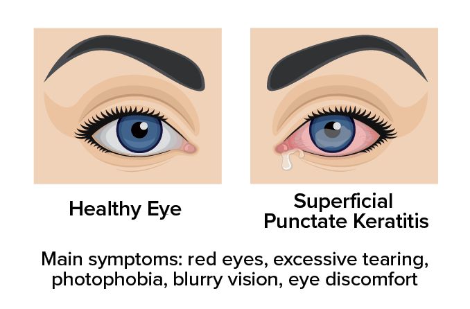 illustration showing the difference between a healthy eye and an eye with Superficial Punctate Keratitis