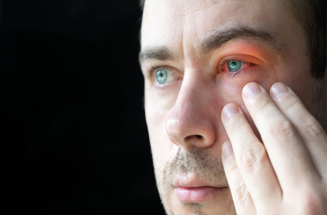 types-of-bug-bites-on-the-eyelid