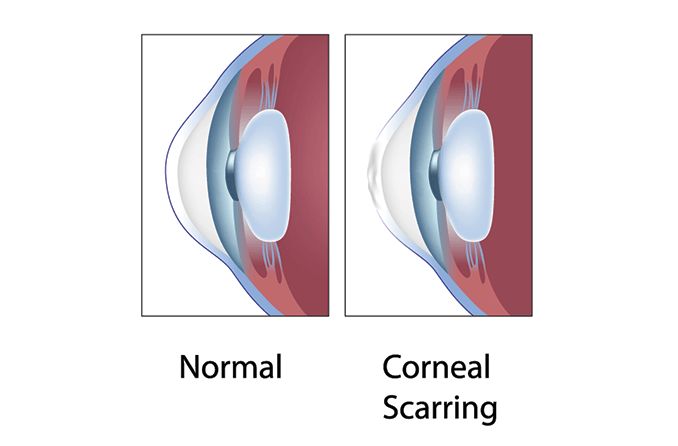 illustration of corneal scarring
