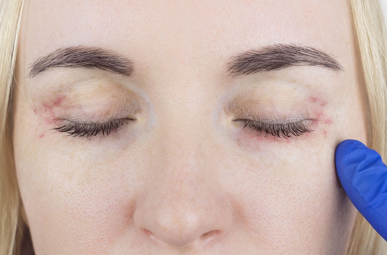 closeup of a woman with ocular rosacea