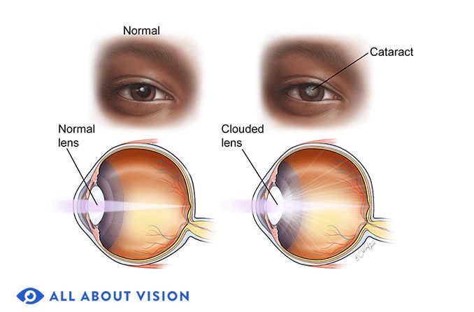 Eye Diseases: Resources on Conditions and Treatments