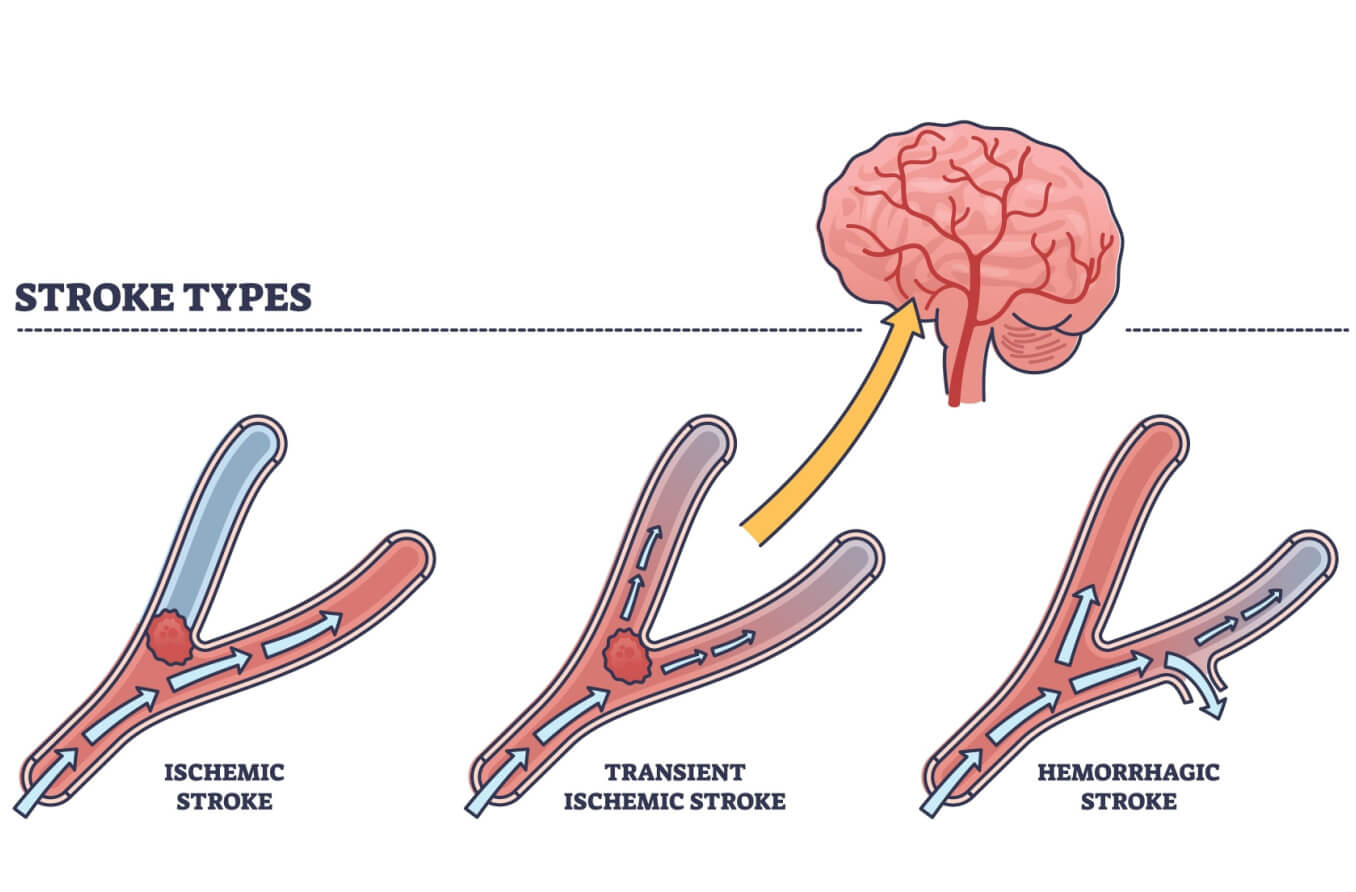 TIA (Transient Ischemic Attack): Symptoms & Treatment