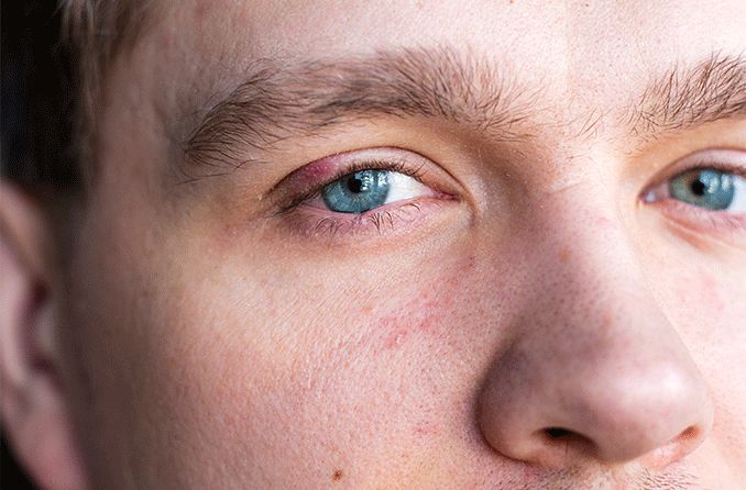 Stye (Sty): What It Is, Causes, Symptoms & Treatment