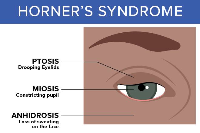 Horner's Syndrome - All About Vision