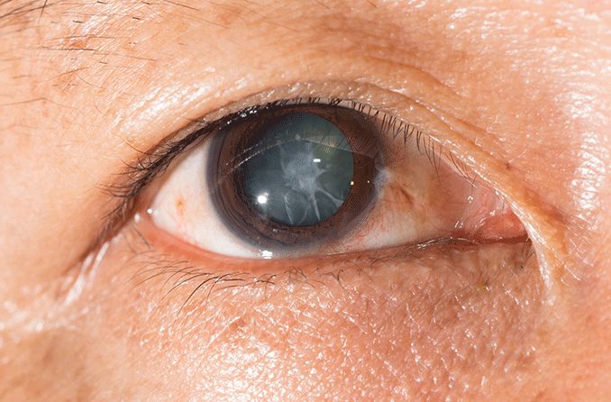 closeup of an eye with a traumatic cataract