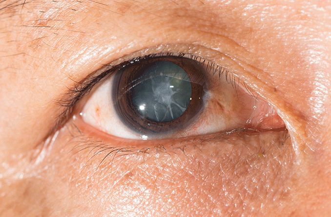 What Is A Traumatic Cataract? - All About Vision