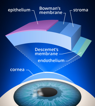 Corneal cross-linking: Helpful for keratoconus?