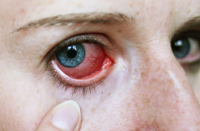 Girl pulls eyelid down to show red irritated eye